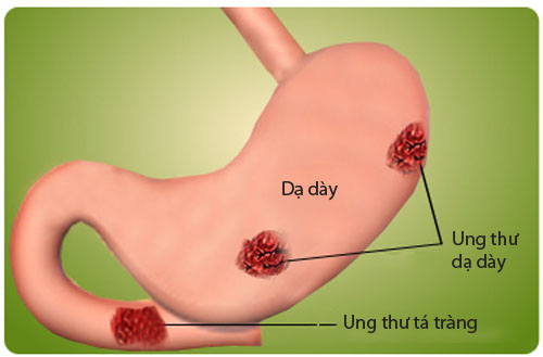 nhung dieu can biet ve da day - Những điều bạn cần biết về viêm loét dạ dày